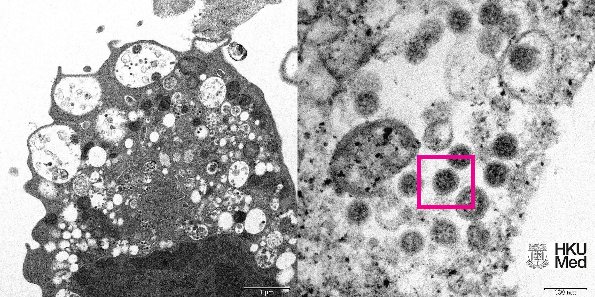 Отсутствие коронавируса. Омикрон-штамм SARS-cov-2. Электронная микрофотография коронавируса. Вирус коронавируса под микроскопом. Омикрон коронавирус.